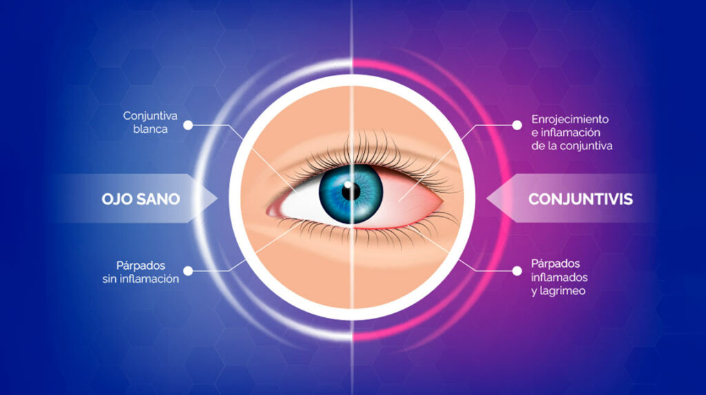 síntomas conjuntivitis alérgica